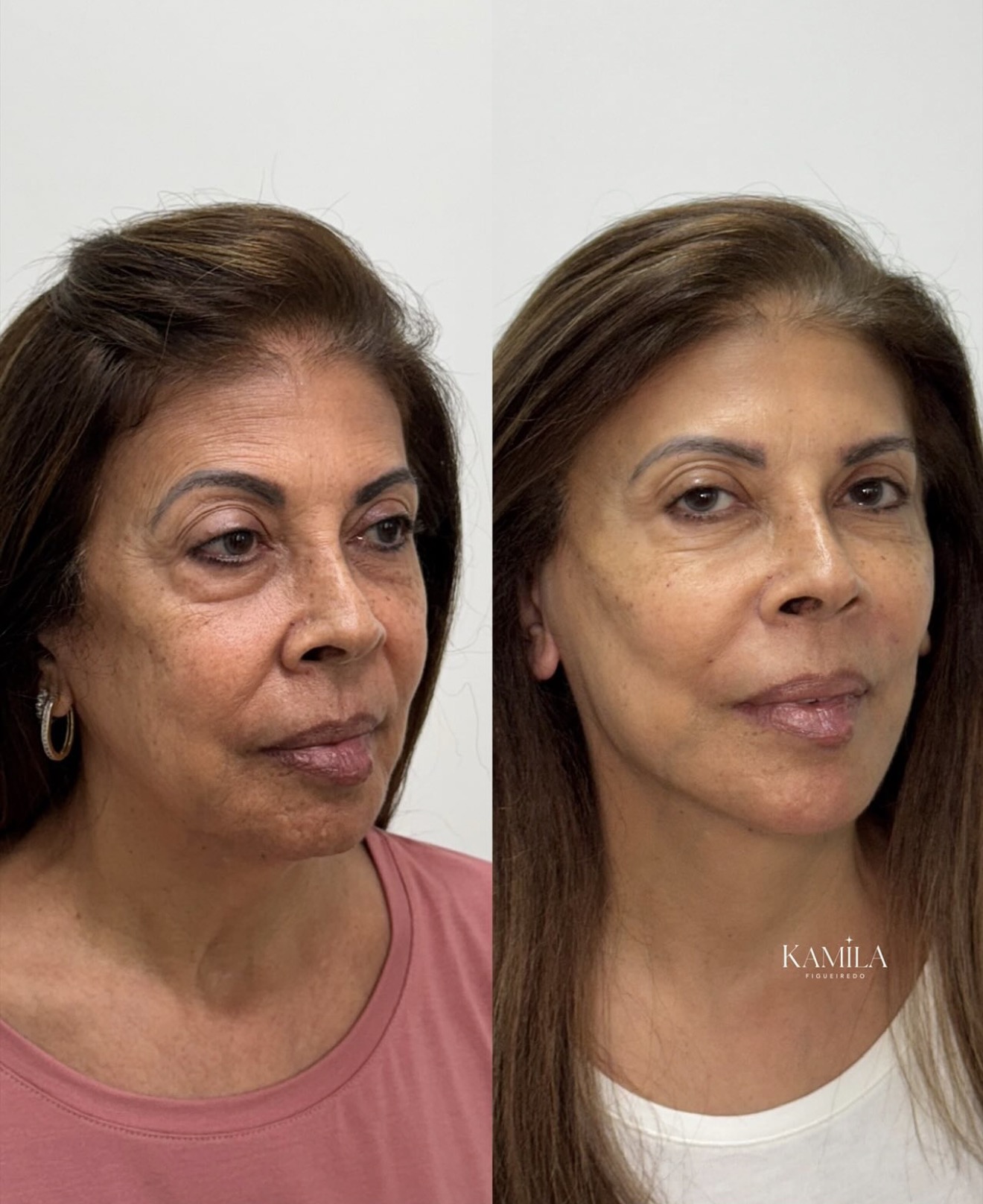 Resultado de rejuvenescimento facial — caso 4